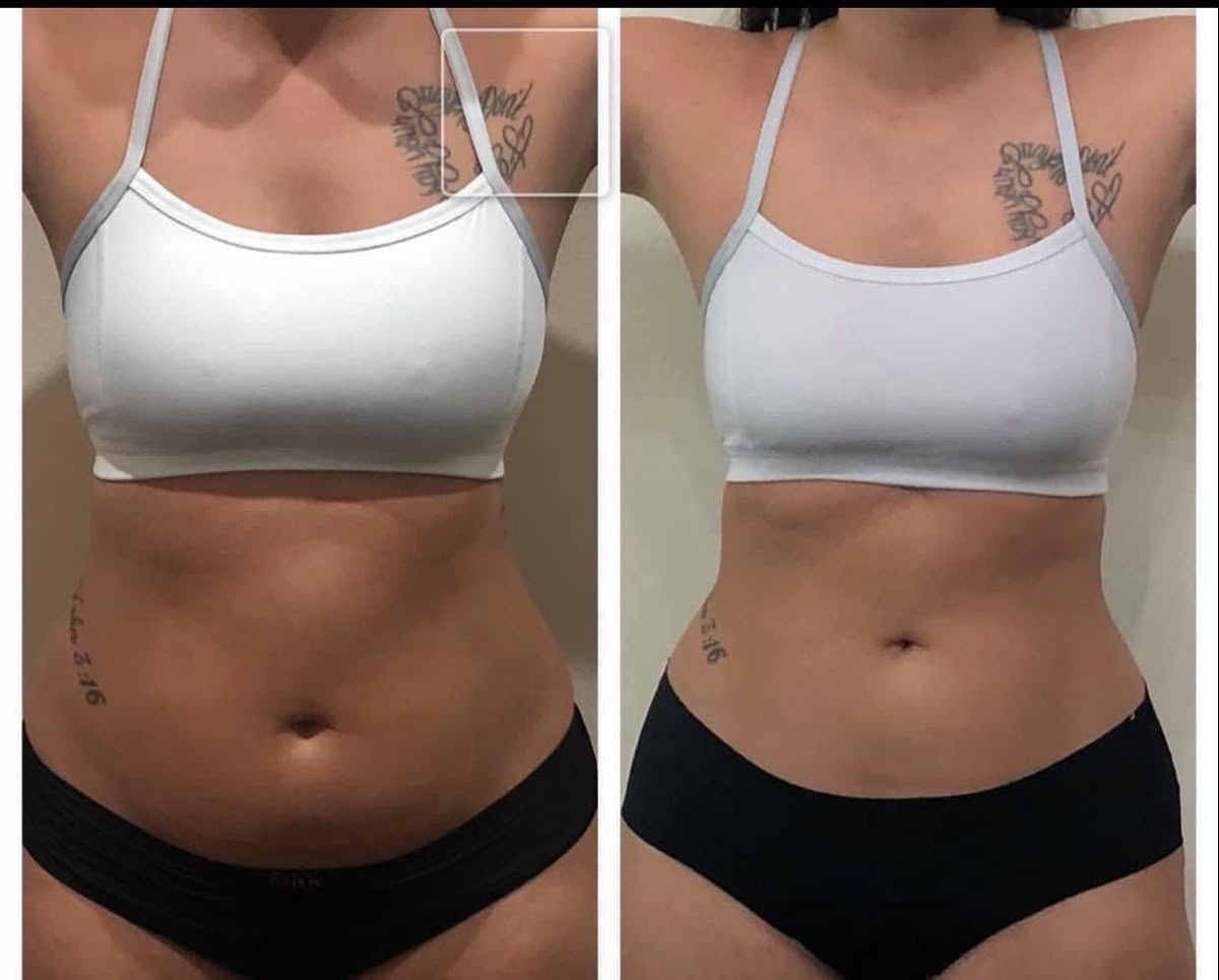 Caso 2 — torso frontal