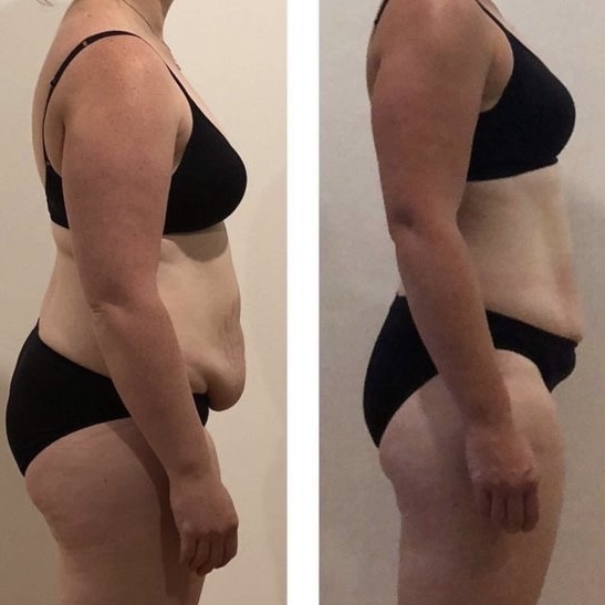 Transformación de paciente: inicio vs mes 3 con retatrutida